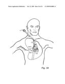 Device, A Kit And A Method For Treatment Of Disorders In The Heart Rhythm Regulation System diagram and image