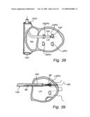 Device, A Kit And A Method For Treatment Of Disorders In The Heart Rhythm Regulation System diagram and image