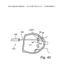 Device, A Kit And A Method For Treatment Of Disorders In The Heart Rhythm Regulation System diagram and image