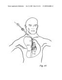 Device, A Kit And A Method For Treatment Of Disorders In The Heart Rhythm Regulation System diagram and image