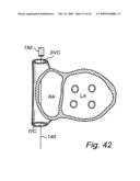 Device, A Kit And A Method For Treatment Of Disorders In The Heart Rhythm Regulation System diagram and image