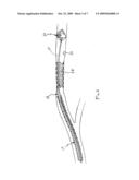 Steerable Endovascular Retrieval Device diagram and image