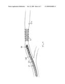 Steerable Endovascular Retrieval Device diagram and image