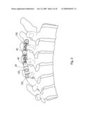 Spinous process stabilization device and method diagram and image