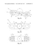 Spinous process stabilization device and method diagram and image