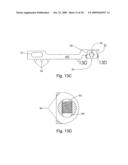 Spinous process stabilization device and method diagram and image