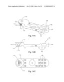 Spinous process stabilization device and method diagram and image