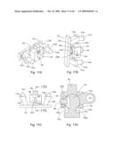 Spinous process stabilization device and method diagram and image