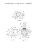 Spinous process stabilization device and method diagram and image