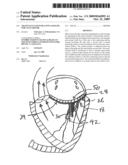 TRANSVALVULAR INTRAANNULAR BAND FOR VALVE REPAIR diagram and image