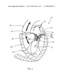 TRANSVALVULAR INTRAANNULAR BAND FOR VALVE REPAIR diagram and image