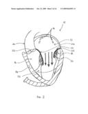 TRANSVALVULAR INTRAANNULAR BAND FOR VALVE REPAIR diagram and image