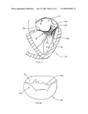 TRANSVALVULAR INTRAANNULAR BAND FOR VALVE REPAIR diagram and image