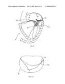 TRANSVALVULAR INTRAANNULAR BAND FOR VALVE REPAIR diagram and image