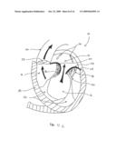 TRANSVALVULAR INTRAANNULAR BAND FOR VALVE REPAIR diagram and image