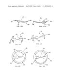 TRANSVALVULAR INTRAANNULAR BAND FOR VALVE REPAIR diagram and image