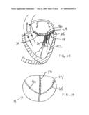 TRANSVALVULAR INTRAANNULAR BAND FOR VALVE REPAIR diagram and image