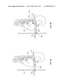 ARTICULATING CANNULA ACCESS DEVICE diagram and image