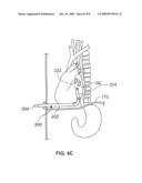 ARTICULATING CANNULA ACCESS DEVICE diagram and image