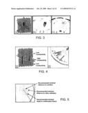 MARGIN DETERMINATION/TUMOR CELL MIGRATION diagram and image