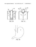 APPARATUS AND METHODS FOR PERFORMING MUCOSECTOMY diagram and image