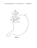 APPARATUS AND METHODS FOR PERFORMING MUCOSECTOMY diagram and image