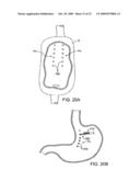 APPARATUS AND METHODS FOR PERFORMING MUCOSECTOMY diagram and image