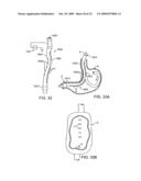 APPARATUS AND METHODS FOR PERFORMING MUCOSECTOMY diagram and image