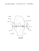 GENERATION OF A COMPUTERIZED BONE MODEL REPRESENTATIVE OF A PRE-DEGENERATED STATE AND USEABLE IN THE DESIGN AND MANUFACTURE OF ARTHROPLASTY DEVICES diagram and image