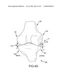 GENERATION OF A COMPUTERIZED BONE MODEL REPRESENTATIVE OF A PRE-DEGENERATED STATE AND USEABLE IN THE DESIGN AND MANUFACTURE OF ARTHROPLASTY DEVICES diagram and image