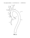 Endovascular Prosthesis for Ascending Aorta diagram and image