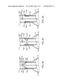 Prosthesis Fixation Apparatus and Methods diagram and image