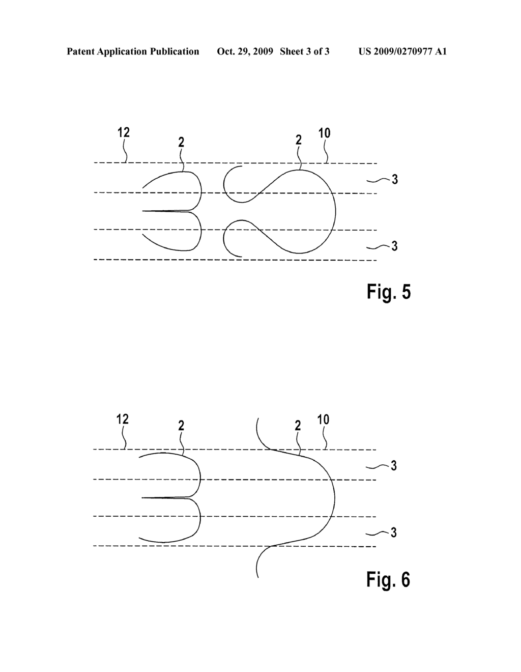 STENT FIXATION SYSTEM - diagram, schematic, and image 04