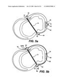 Methods and Devices for Improving Mitral Valve Function diagram and image