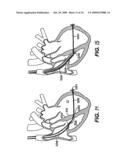 Methods and Devices for Improving Mitral Valve Function diagram and image