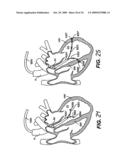 Methods and Devices for Improving Mitral Valve Function diagram and image