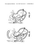 Methods and Devices for Improving Mitral Valve Function diagram and image