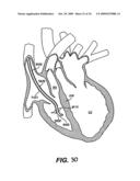 Methods and Devices for Improving Mitral Valve Function diagram and image