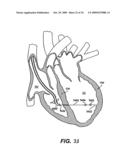 Methods and Devices for Improving Mitral Valve Function diagram and image