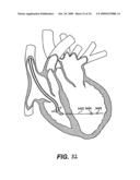 Methods and Devices for Improving Mitral Valve Function diagram and image