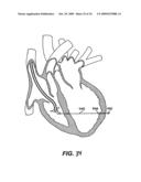 Methods and Devices for Improving Mitral Valve Function diagram and image