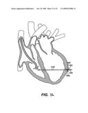 Methods and Devices for Improving Mitral Valve Function diagram and image