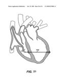 Methods and Devices for Improving Mitral Valve Function diagram and image
