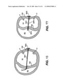 Methods and Devices for Improving Mitral Valve Function diagram and image