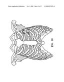 Ablation probe with stabilizing member diagram and image