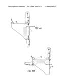 SHEATHS FOR EXTRA-ARTICULAR IMPLANTABLE SYSTEMS diagram and image