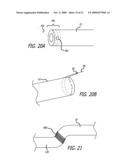 SHEATHS FOR EXTRA-ARTICULAR IMPLANTABLE SYSTEMS diagram and image