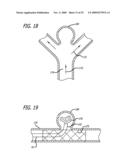 FILAMENTARY DEVICES FOR TREATMENT OF VASCULAR DEFECTS diagram and image