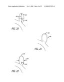 FILAMENTARY DEVICES FOR TREATMENT OF VASCULAR DEFECTS diagram and image