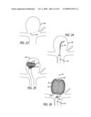 FILAMENTARY DEVICES FOR TREATMENT OF VASCULAR DEFECTS diagram and image